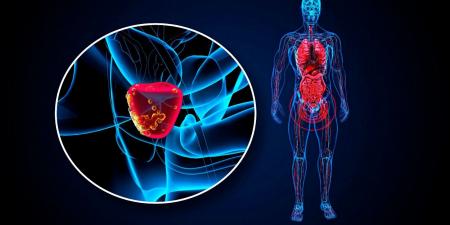 باحثون يبتكرون طريقة جديدة لعلاج سرطان البروستاتا العدواني - في المدرج