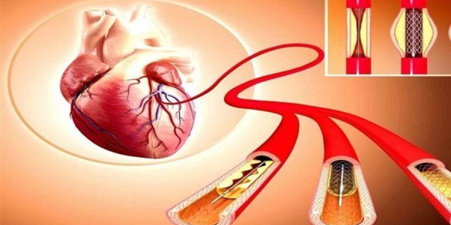 روسيا.. تطوير تقنية الطباعة ثلاثية الأبعاد للدعامات المستخدمة في علاج أمراض القلب التاجية